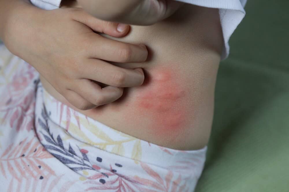 การแพ้น้ำลายยุงทำให้เกิดการอักเสบ และผื่นแดงขึ้นที่บริเวณที่ถูกกัด