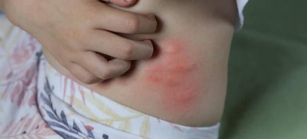 การแพ้น้ำลายยุงทำให้เกิดการอักเสบ และผื่นแดงขึ้นที่บริเวณที่ถูกกัด